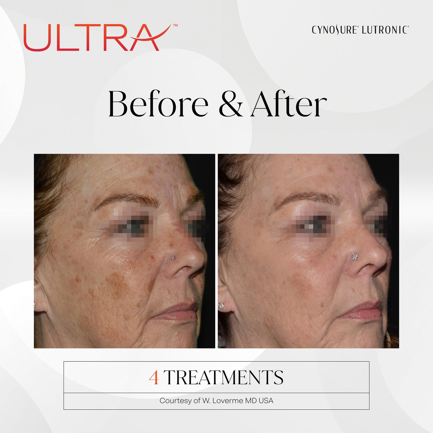 Skin Resurfacing Laser