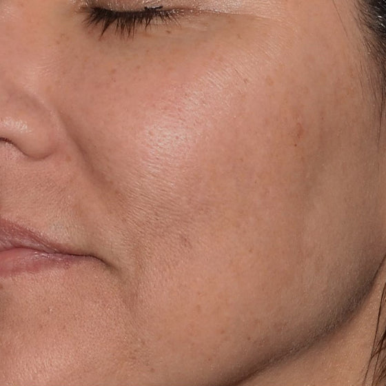 Delay-Aging Lifting and Collagen Building (Facial Balancing)