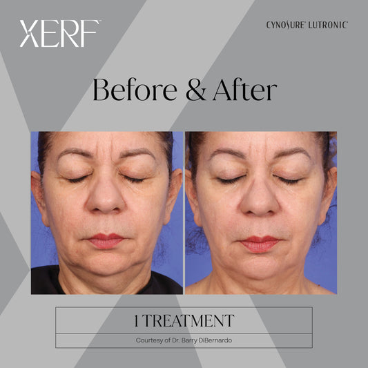 XERF SKIN TIGHTENING LASER-Body