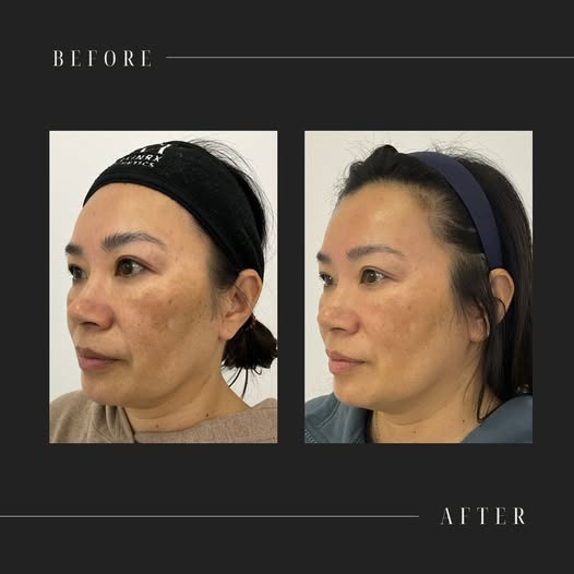 Skin Brightening Laser Treatment