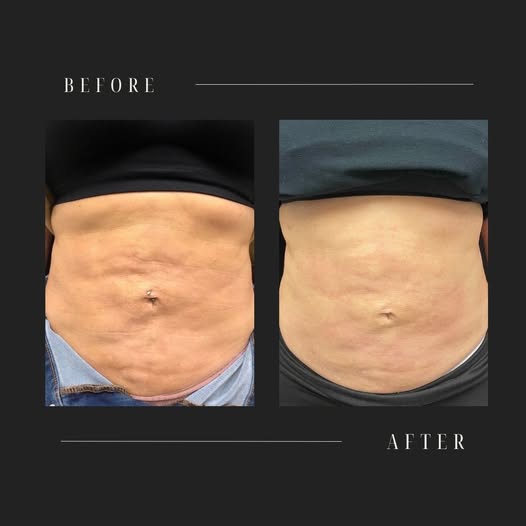 Skin Tightening Laser