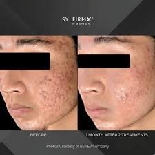 Acne Scar Treatment-Adults