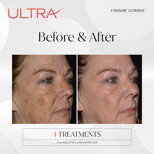 Skin Resurfacing Laser