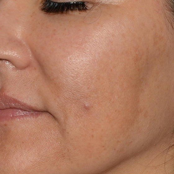 Delay-Aging Lifting and Collagen Building (Facial Balancing)